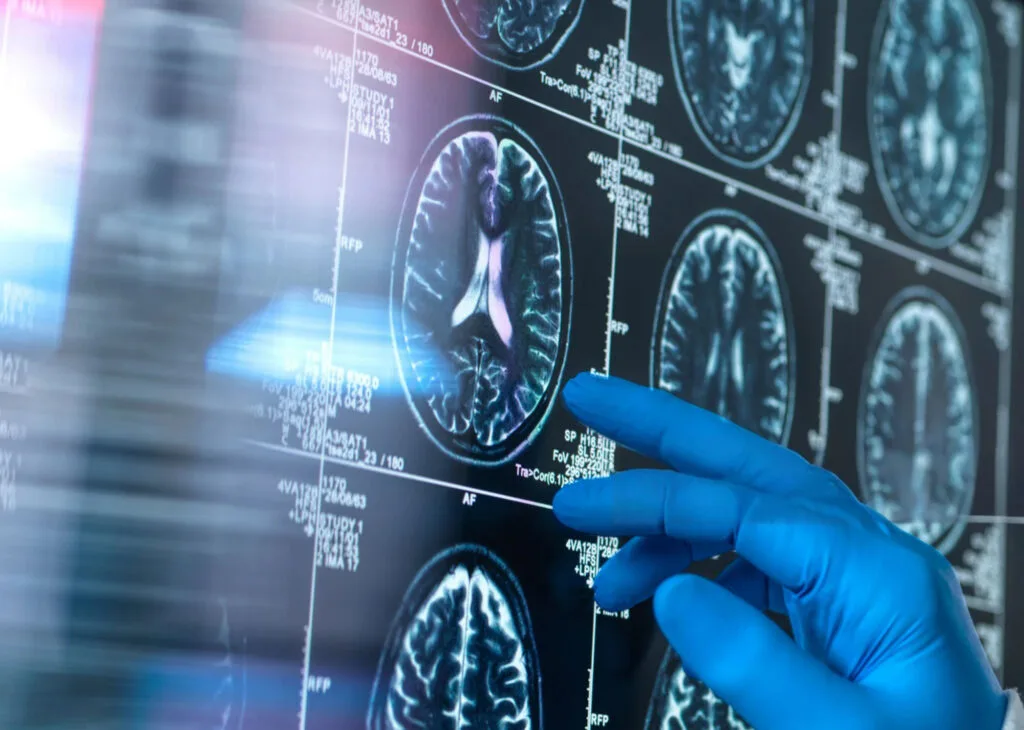 A doctor's hand wearing a blue surgical glove hovers over brain imaging scans